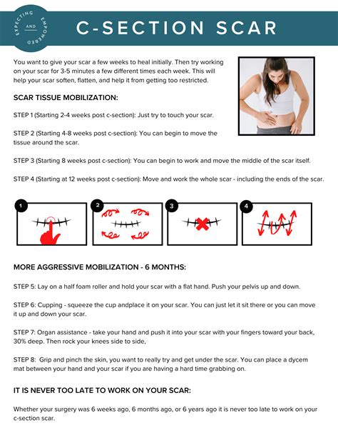 cesarean section scars chart